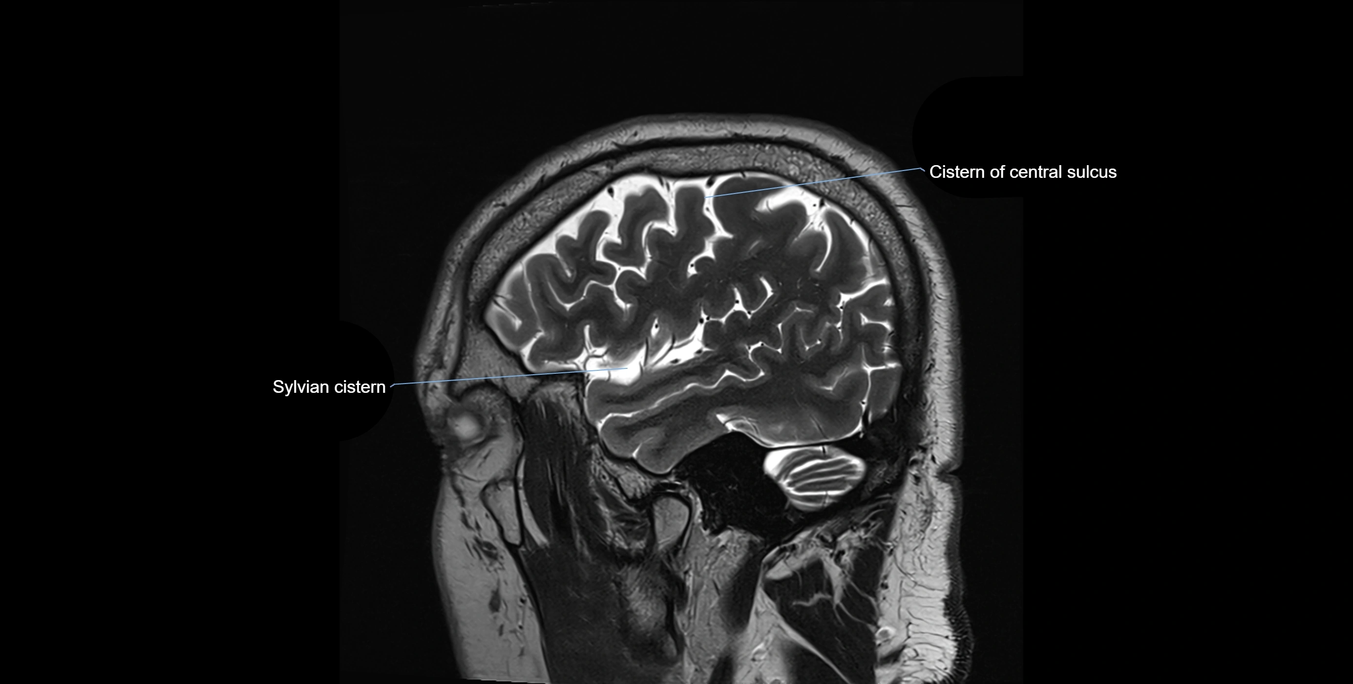 Brain cisterns  and ventricles sagittal anatomy 3T MRI image-img-00001-00008.webp